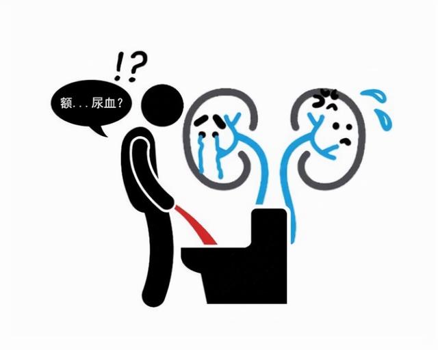 尿路结石