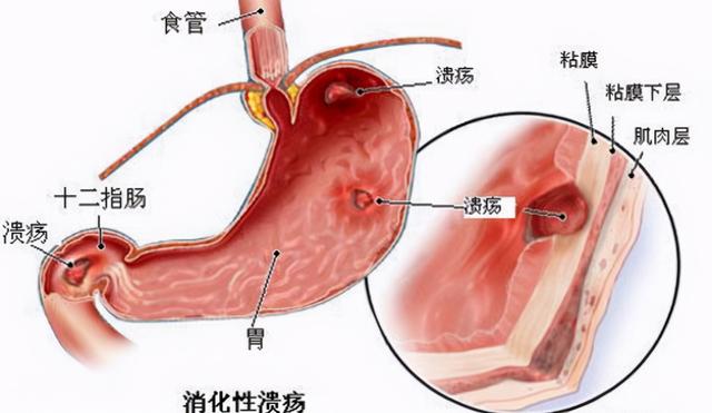 胃疼后背也疼是怎么回事