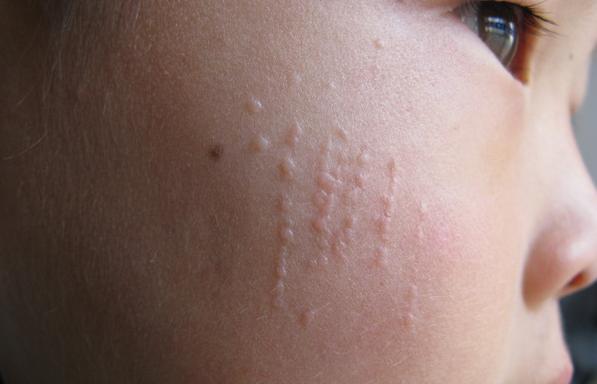 汗管瘤中药治疗效果