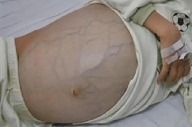 肝癌腹水难消，只能反复抽腹水？老中医经验分享，应对顽固腹水