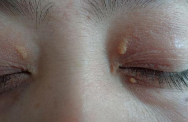 心脏好不好看脸就知道，脸上出现4种特征要警惕，赶紧检查心脏