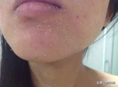 天生鸡皮肤是什么