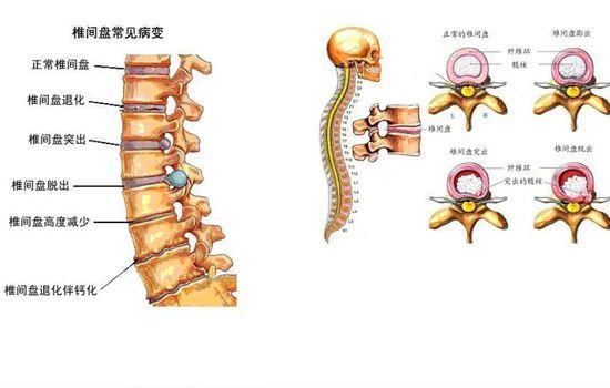 腰椎间盘突出怎么治疗