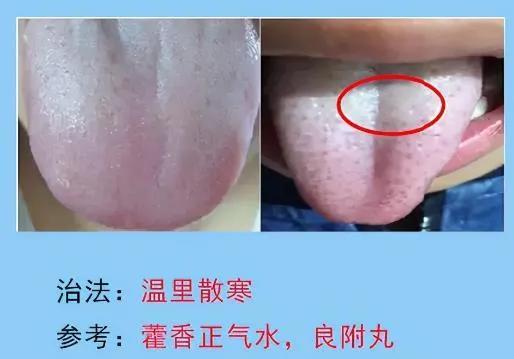 脾胃病的常见舌苔分析，脾胃不好的人要多多了解，你是图几？