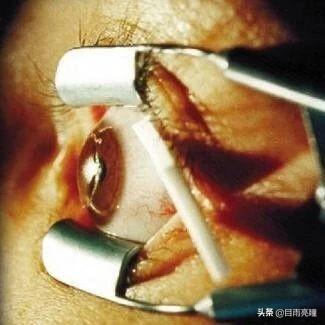 眼角化脓用针挑破