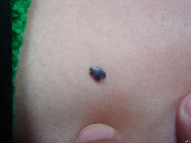 黑色素瘤和脂溢性角化病的区别