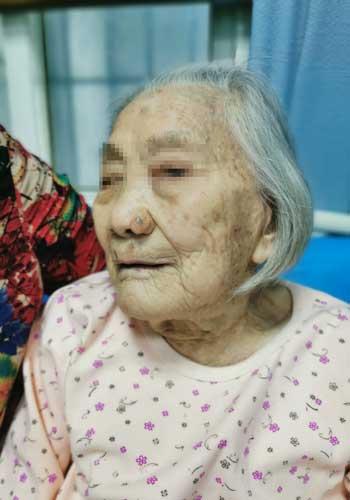 角化棘皮瘤手术用插导尿管么