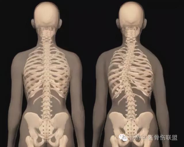 青少年预防颈椎病的四个要点