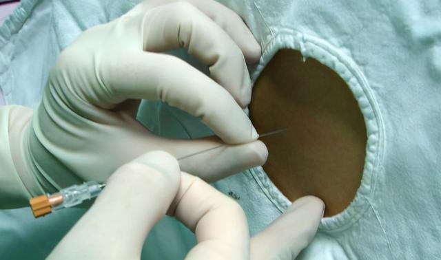 孕妇在剖腹产术后一直腰酸背痛，真的是打麻醉造成的吗？