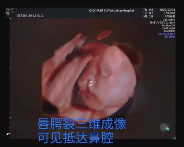 你也能看懂的胎儿畸形——病例分享