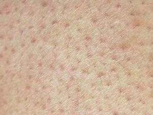 洗面奶能消除毛周角化吗