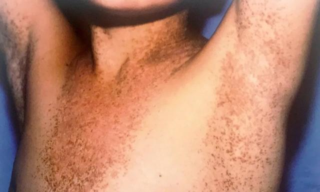 醋加甘油治疗鸡皮肤有副作用吗