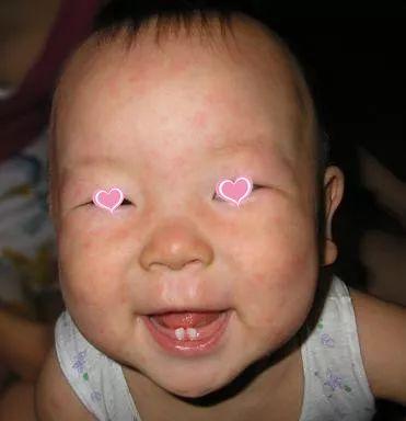 孩子全身类似鸡皮疙瘩