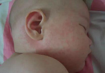 5岁儿童身上大片鸡皮疙瘩