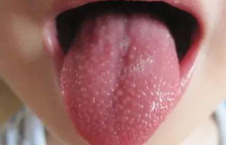 孩子全身类似鸡皮疙瘩