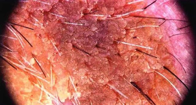 皮肤指异性角化