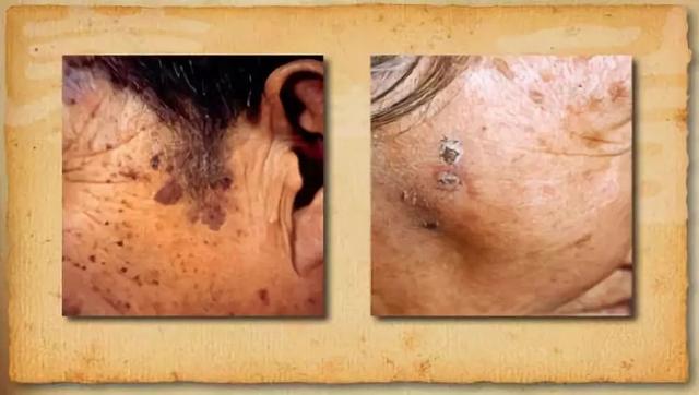 皮肤指异性角化