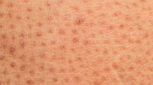 皮肤角化脱皮消银颗粒