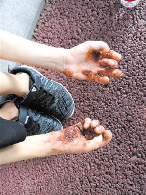 角化病会越来越严重吗