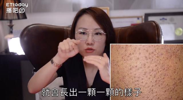 毛周角化症图片面部怎么改善