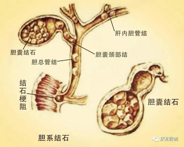 有胆结石怎么办