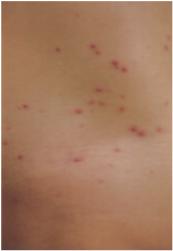 谍影对称性红斑角化症