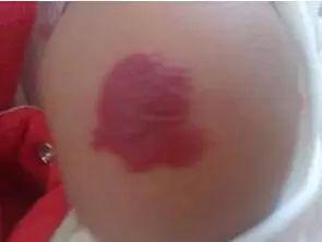 小孩脸部毛周角化图片