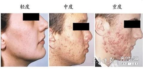 毛周角化症可以拔罐治疗吗