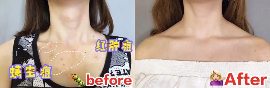 鸡皮疙瘩抓破后红肿
