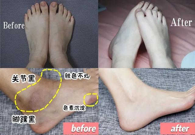 鸡皮疙瘩抓破后红肿