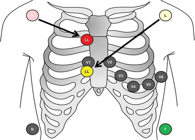 心電圖所有導聯的放置位置,肢體導聯電極錯接的心電圖分析及鑑別