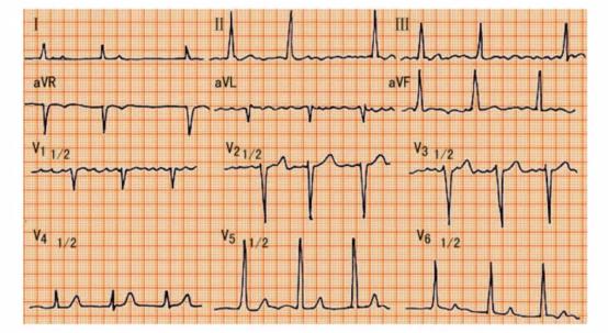 完左和完右心电图口诀,看懂心电图的十大口诀