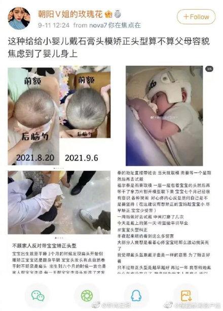 宝妈不顾家人反对给宝宝戴石膏矫正头型 你怎么看？