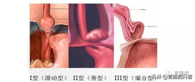 食道癌部分角化