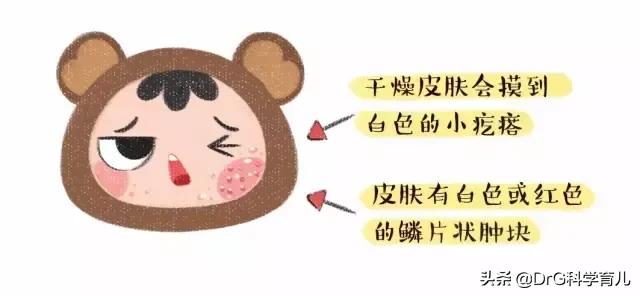 红疹抓破后呈鱼鳞状