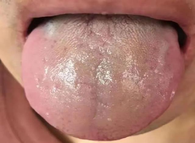 舌头胖大用参苓白术丸没用？胖大舌也分三种，教你如何对症调理