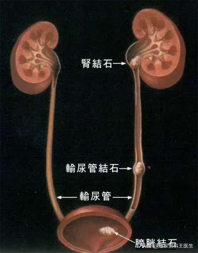 尿酸高，如何让尿酸排出体外？医生总结：3个办法，实用又有效