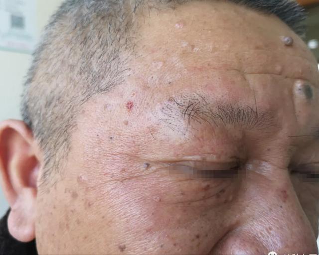 肥厚性日光性角化症