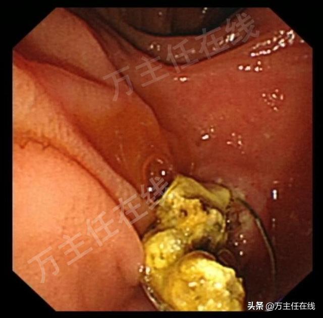 孕34周腹痛入院，多科通力合作挽救胆管结石伴胆管炎妊娠晚期孕妇