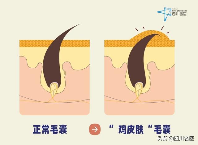 去医院能看好鸡皮肤吗