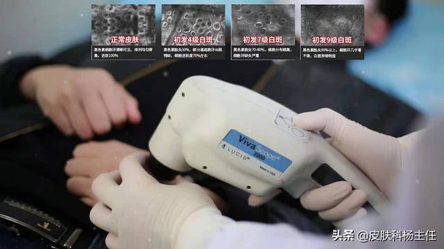 皮肤科皮损取材检查是什么意思