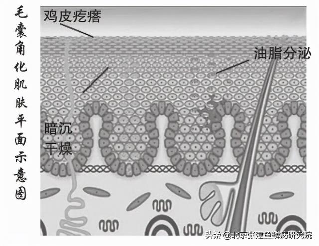 角化不良错