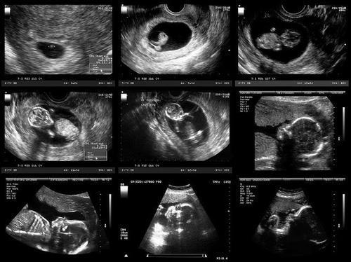 怀孕19周胎儿彩超图片