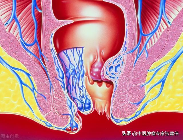 為什么“痔瘡”變成了直腸癌?痔瘡會癌變嗎?醫生：二者很容易誤診
