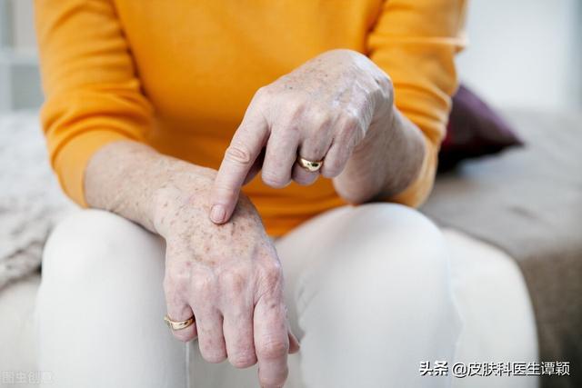 脂溢性角化冷冻治疗