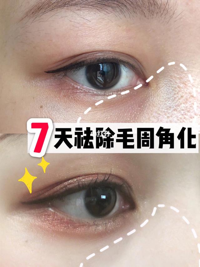 激光能去除毛周角化