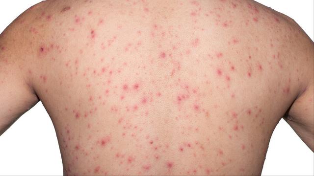 鸡皮肤能激光消除吗