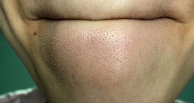 鼻子周围的毛周角化