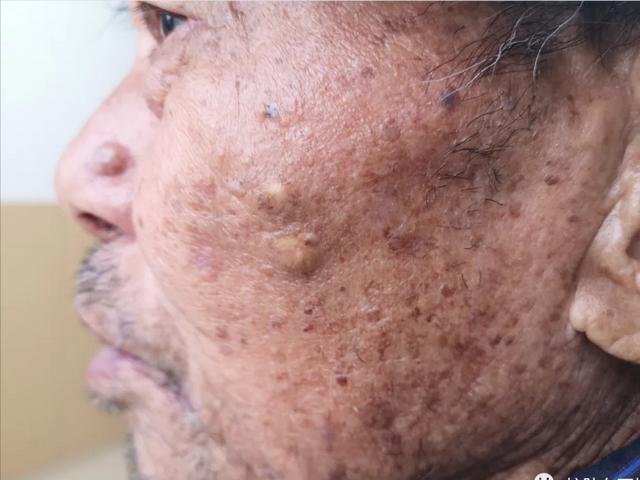 肥厚性日光性角化症