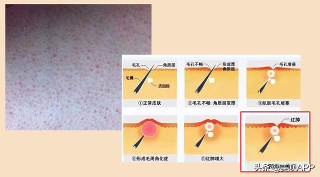 毛囊角化症与毛周角化症的区别